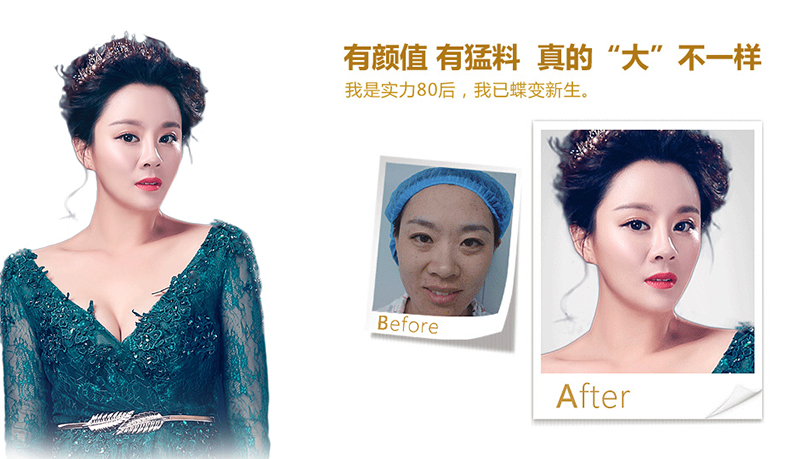 宜昌脂肪移植、隆鼻